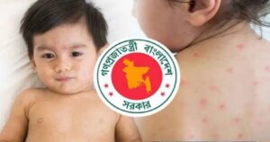 হামের উপসর্গে প্রাণ হারাল ৭ শিশু, চট্টগ্রামে মৃত্যু নেই